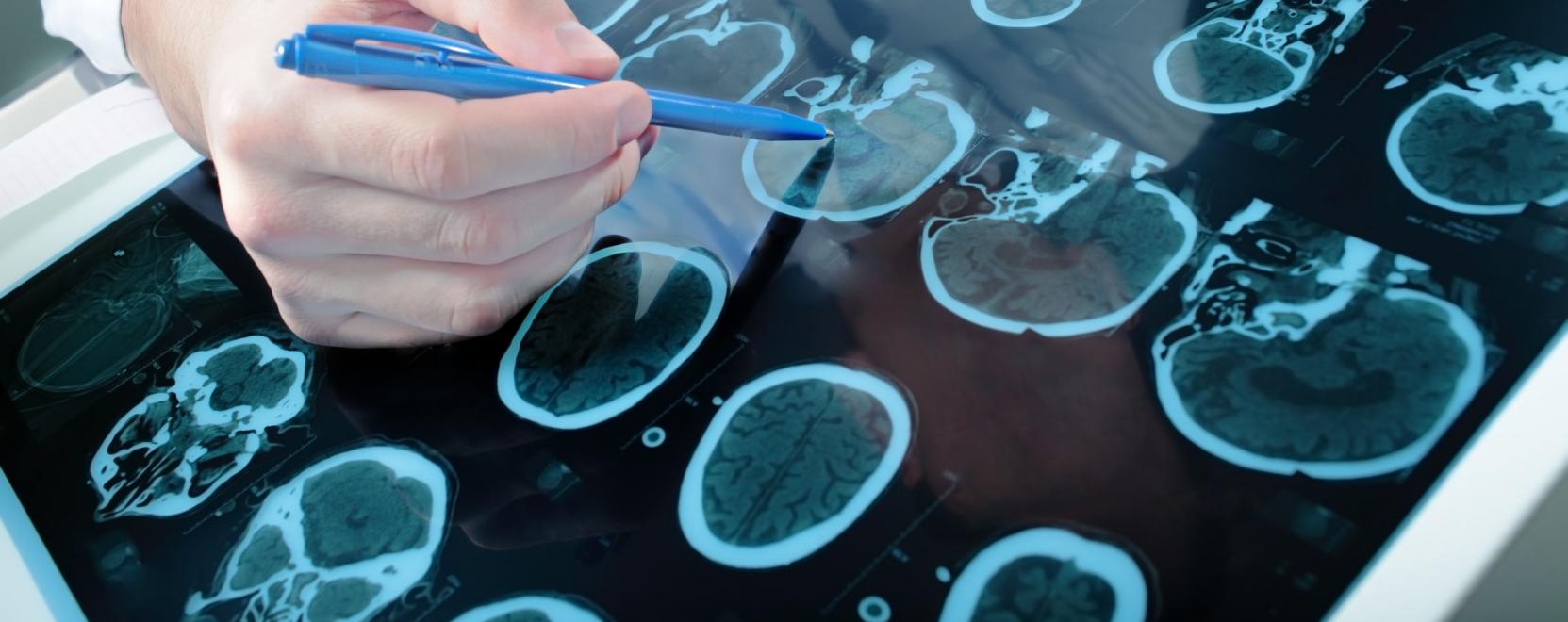Az AI is segíthet a Parkinson-kór felismerésében