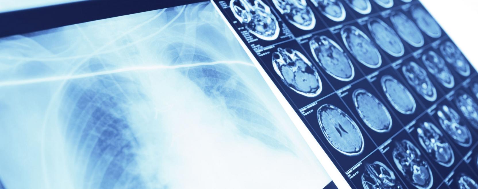 A robotprogram pillanatok alatt felismeri a koronav&iacute;rust