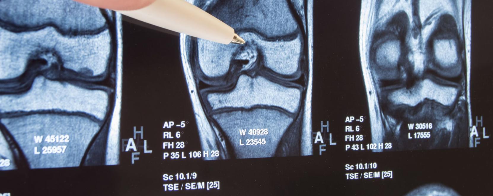 Robot seg&iacute;ti a sikeres t&eacute;rdprot&eacute;zis műt&eacute;teket
