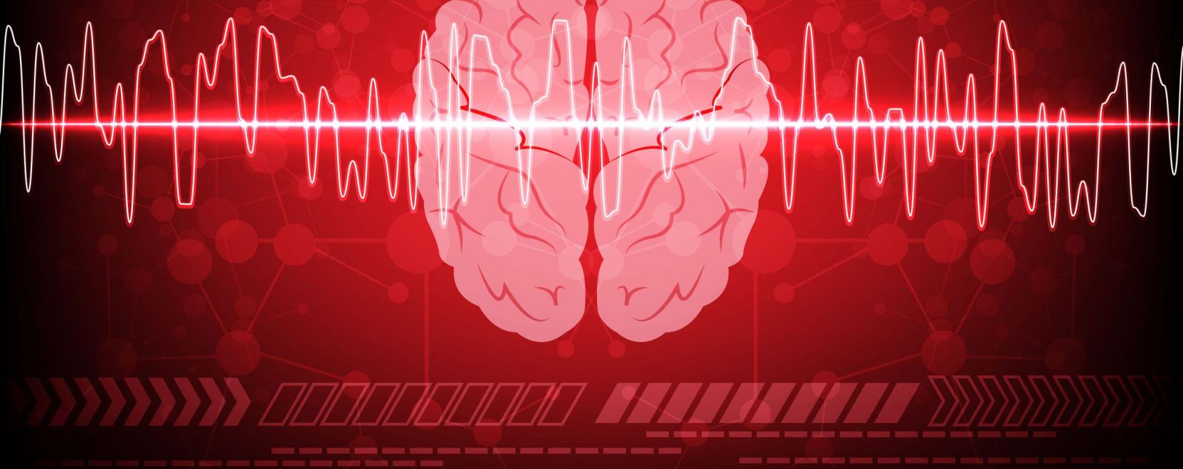 Stroke-előrejelz&eacute;s: amikor minden perc sz&aacute;m&iacute;t