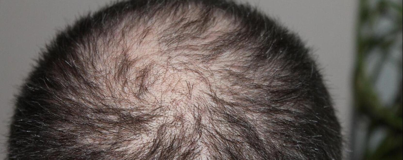 A hajhull&aacute;s &eacute;s kopaszs&aacute;g k&uuml;l&ouml;nb&ouml;ző t&iacute;pusai